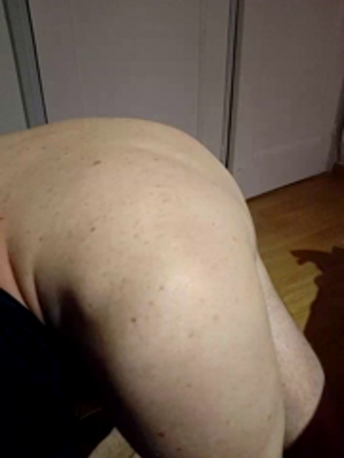 papiculo86